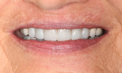 Closeup of smile after new dental crown and porcelain veneers
