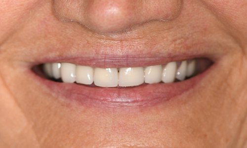 Closeup of smile with old, discolored dental crown