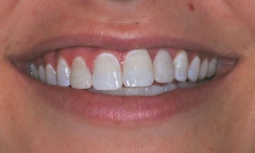 Smile with dental implant replaced teeth and porcelain veneer correction