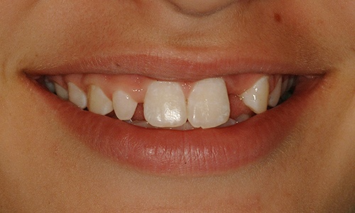 Patient's smile with missing and undersized teeth