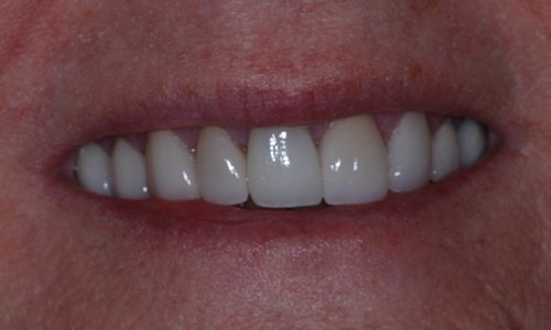 Flawless smile after complete smile makeover