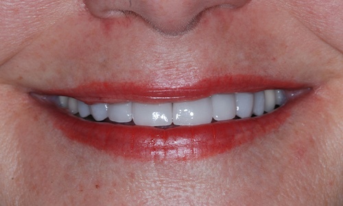 Flawless smile after full mouth rehabilitation