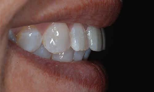 New dental crowns recreating beautiful smile