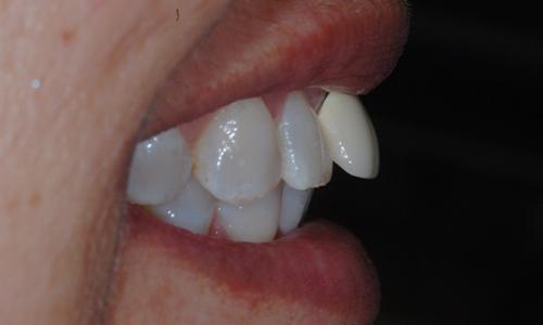 Dental restoration placed angling outward