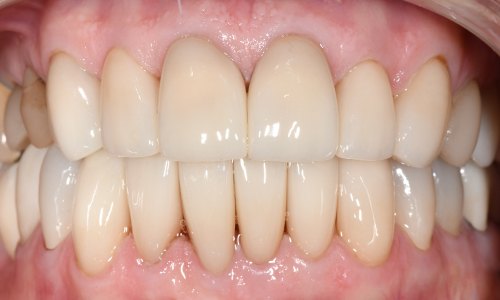Perfect smile after full mouth rehabilitation