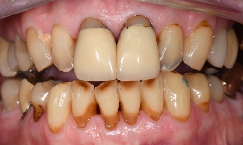 Smile with several cosmetic and functional oral health concerns