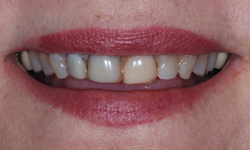 Smile with discolored dental bonding