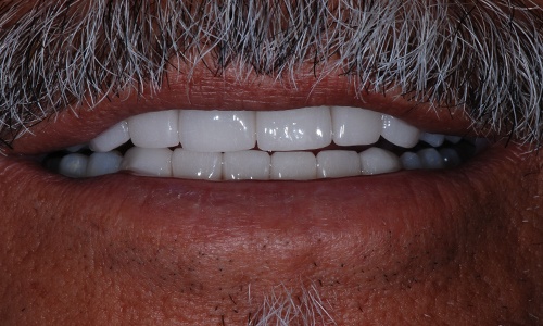 Smile repaired with porcelain crowns