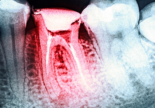 X-ray of damaged tooth before extraction
