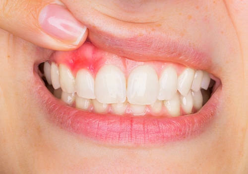 Smile with inflamed and red gum tissue