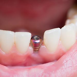 closeup of person smiling with dental implants