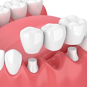 A 3D illustration of a traditional dental bridge