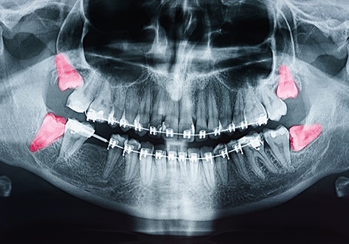 X-ray of a jaw showing 4 wisdom teeth highlighted red