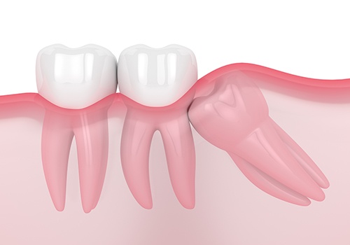 Rendering showing wisdom tooth pushing against neighbor as it grows