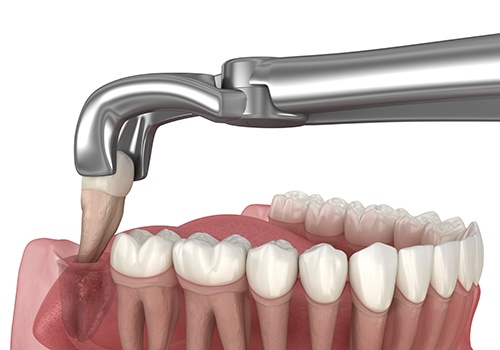 Rendering of forceps grasping wisdom tooth in lower jaw