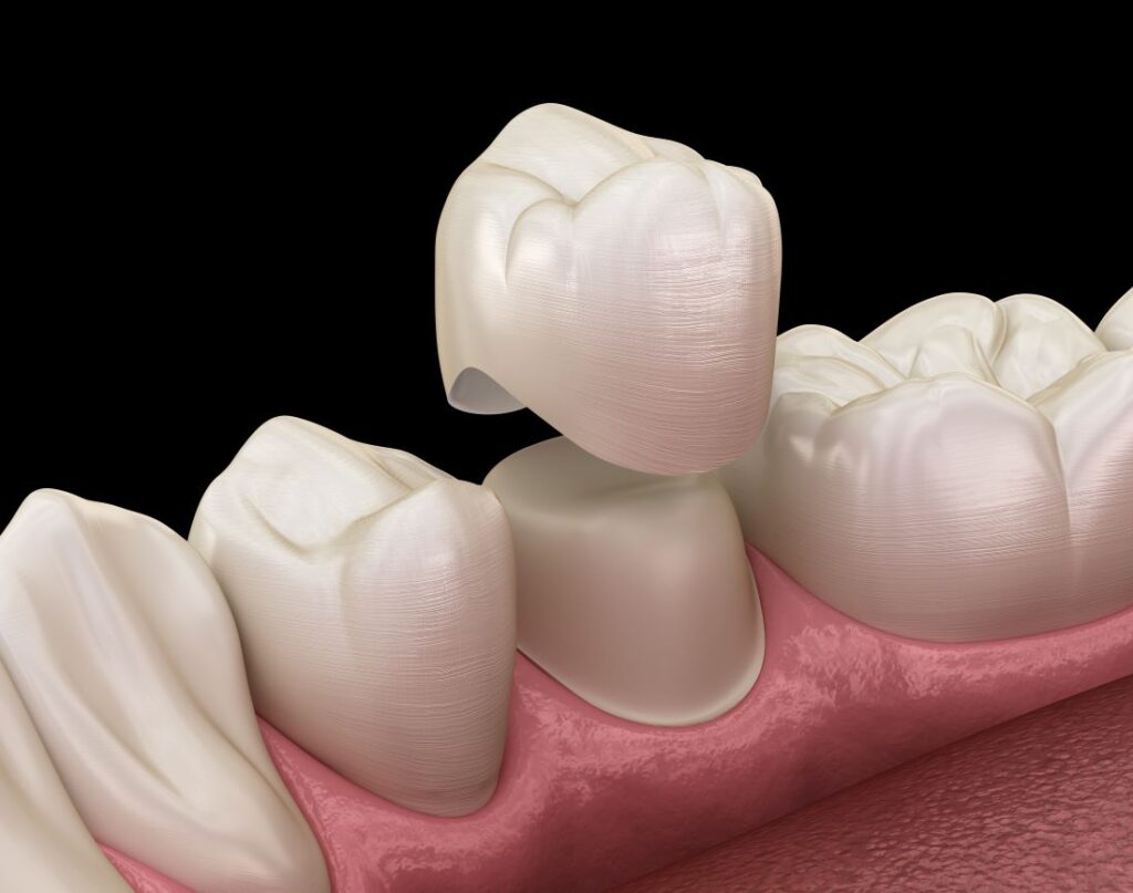 A digital image of a dental crown.